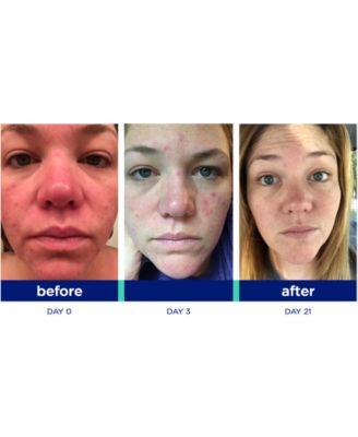 Blemish Kick Duo System