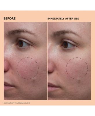 Microdelivery Resurfacing Solution