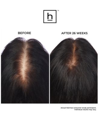 Laserband 82 Comfortflex