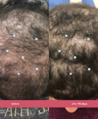 Spectral.CSF Revitalizing Serum For Women With Nanoxidil 5%, 3-Month Supply