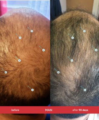 Revita Extra Strength Hair Density Shampoo, 205 ml