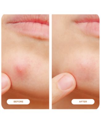 Silk + Salicylic Acid Microdart Pimple Patches 48-Pack