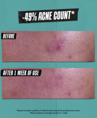 Gently Effective Acne-Treating Cleansing Paste