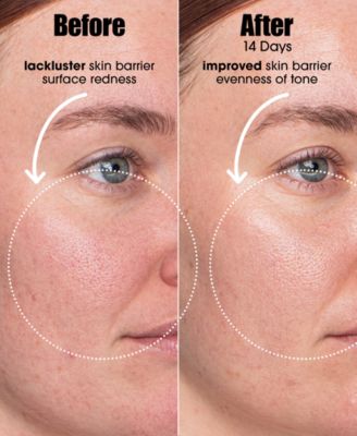 AI Smart Retinoid Serum For Blemish-Prone Skin, 1 oz.