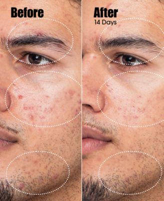 Peacekeeper Acne Treatment Serum, 1 oz.