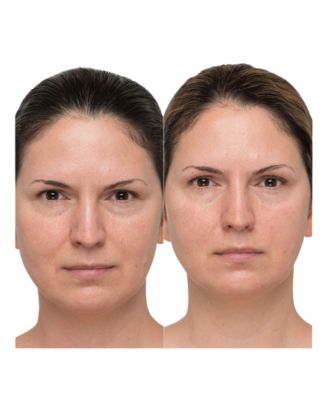 MyoLift Mini Microcurrent Device Bundle