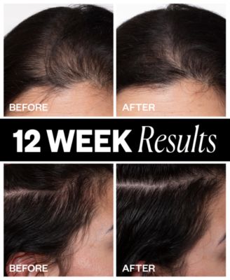 Sponsored Hair Density Scalp Treatment, 2.1 oz.