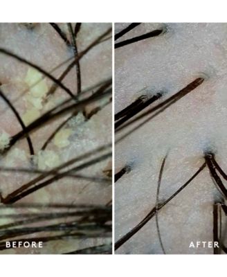 Scalp Remedy Shampoo, 8 oz.