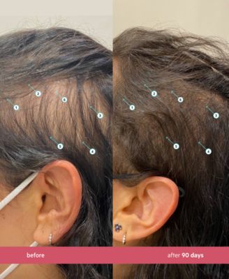 Spectral.CSF Revitalizing Serum For Women With Nanoxidil 5%, 3-Month Supply