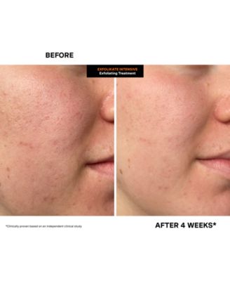 ExfoliKate Intensive Exfoliating Treatment, 2 oz.