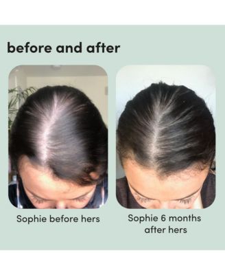 Hers  Hair Regrowth Treatment Minoxidil 5% Topical Foam