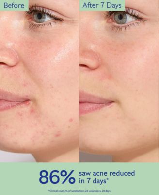 Vinopure Treat and Prevent Blemishes Acne Serum, 1 oz.