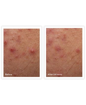 Murad - Acne Control Rapid Relief Acne Spot Treatment, 0.5-oz.