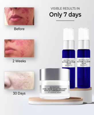 Acne + Acne Scar Discovery Collection with UV Chromophores