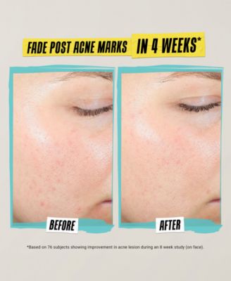 Expertly Clear Acne-Treating & Preventing Lotion