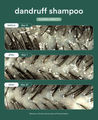 Dandruff Shampoo, 8 oz.