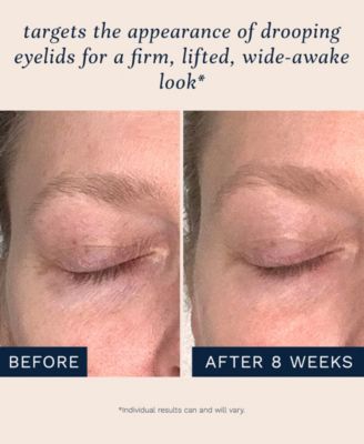 Lid Lifting Treatment Drooping Eyelid Solution, 0.33 Fl. Oz/10ML