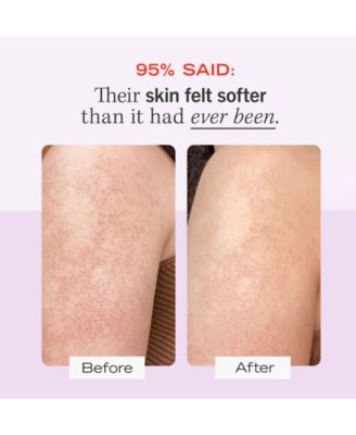 KP Bump Eraser Body Scrub with 10% AHA – Body Exfoliant for Keratosis Pilaris, 8.0 oz.