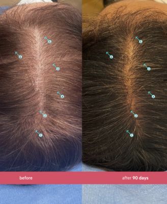 Spectral.CSF Revitalizing Serum For Women With Nanoxidil 5%, 3-Month Supply