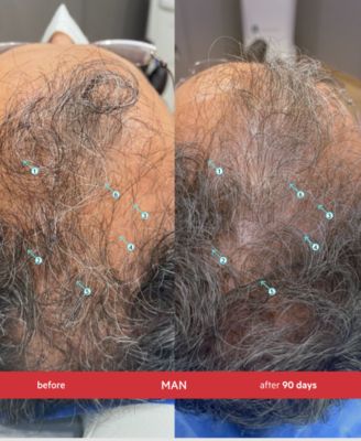 Revita Extra Strength Hair Density Shampoo, 205 ml