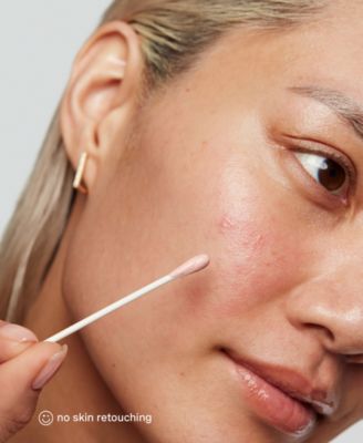 EradiKate Acne Treatment, 1 oz.