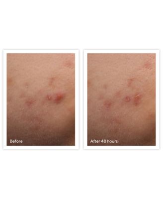 Murad Acne Control Rapid Relief Acne Spot Treatment, 0.5-oz.