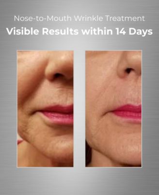Nose-To-Mouth Wrinkle Treatment With UV Chromophores