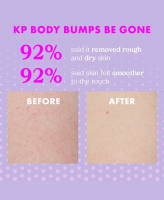 KP Body Bumps Be Gone