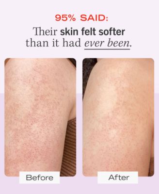 KP Bump Eraser Body Scrub with 10% AHA – Body Exfoliant for Keratosis Pilaris, 8.0 oz.