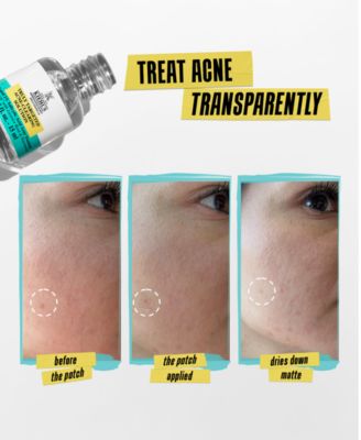Truly Targeted Acne-Clearing Solution