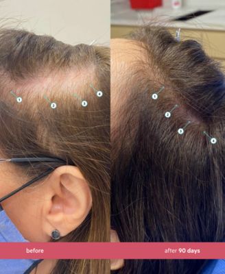 Spectral.CSF Revitalizing Serum For Women With Nanoxidil 5%, 3-Month Supply