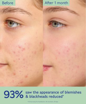 Vinopure Oil-Control Acne Prone Moisturizer, 2 oz.