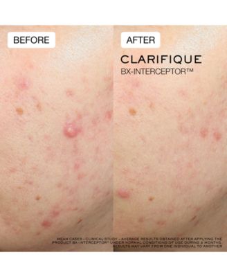 Clarifique Bx-Interceptor Acne Treatment, 1 oz.