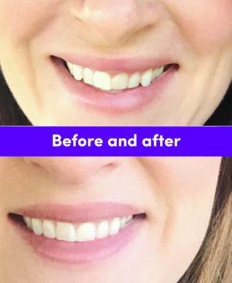 Smile Direct Club New Smile Kit