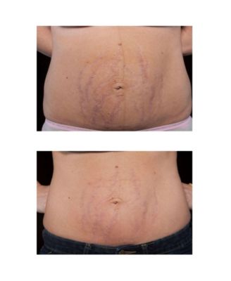 Stretchmark Device