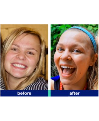 Blemish Relief Lotion