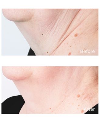 2-Pc. Cold Plasma Plus+ Sub-D/Neck Treatment Set