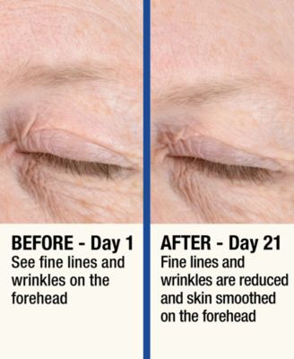 ReMOVE Micro Dermabrasion Device with Cooling Surface