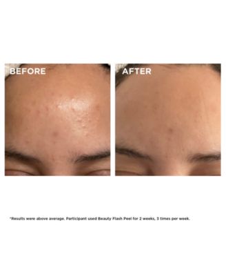 Beauty Flash Peel with BHA & AHA