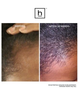 Laserband 41 Comfortflex