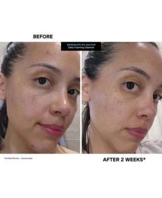 EradiKate Daily Foaming Cleanser Mini