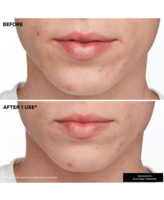 EradiKate Acne Treatment, 1 oz.