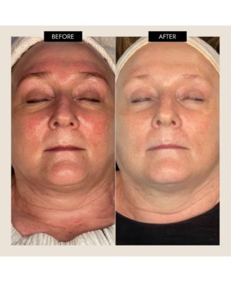 MyoLift TriWave Microcurrent Facial Device