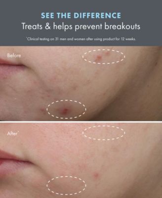 Clear Improvement Acne Clearing Hydrating Lotion, 1.7 oz.