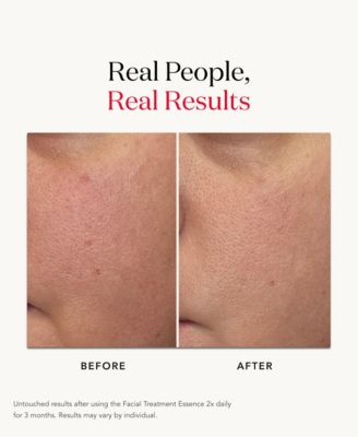 Facial Treatment Essence, 2.5 oz.